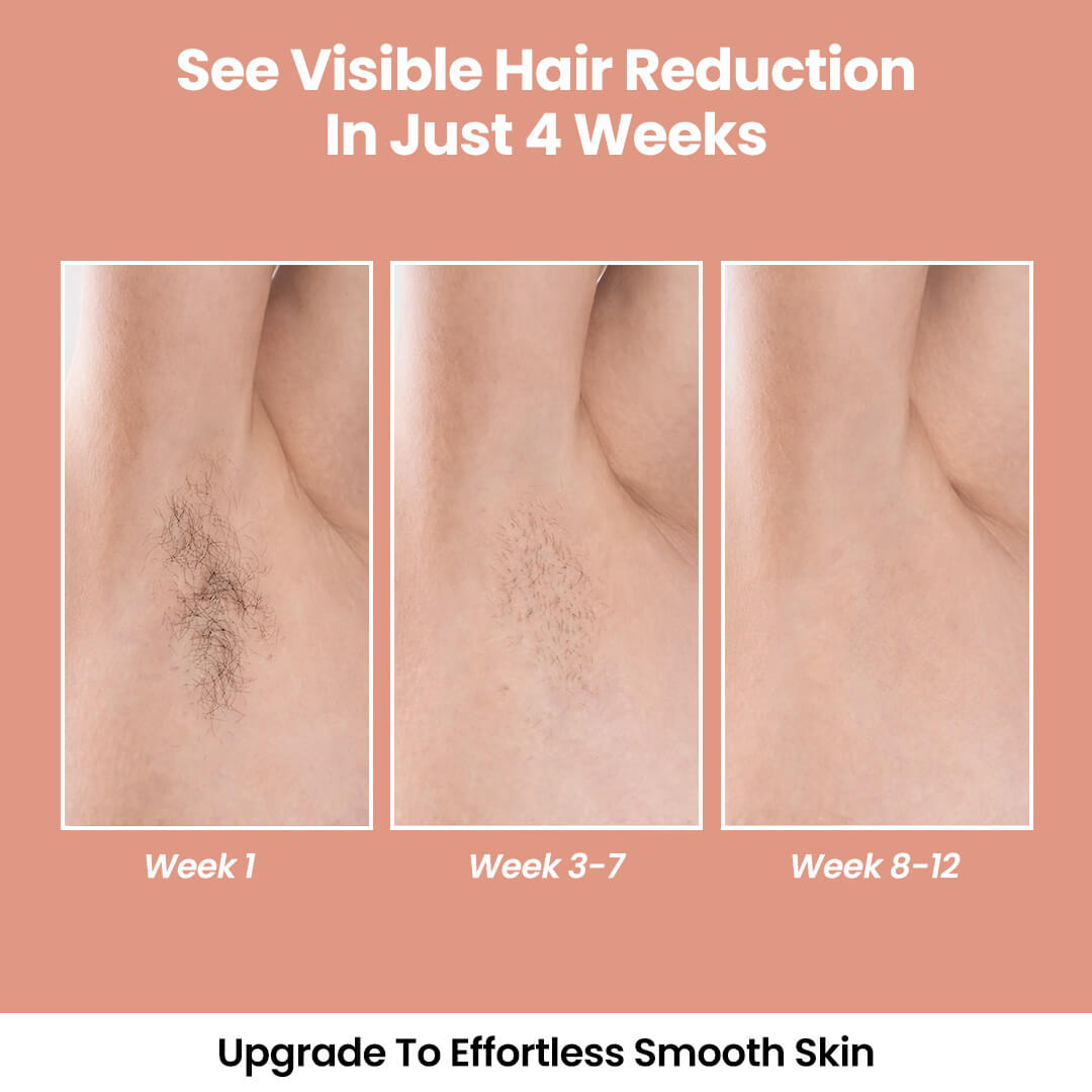 LunaSkin™ Lumière (IPL Hair Removal)